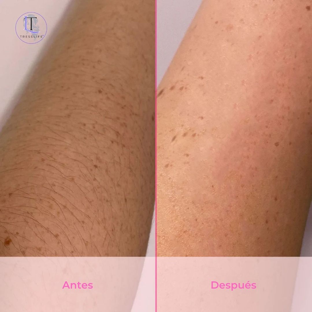 LumiSkin™ (Depiladora Laser IPL)