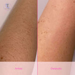 LumiSkin™ (Depiladora Laser IPL)